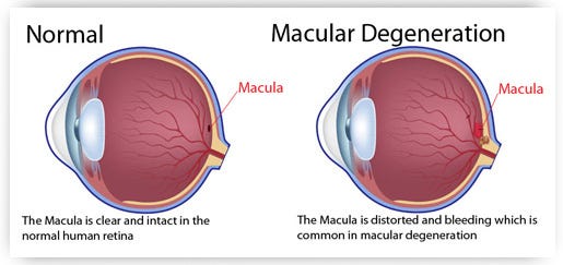 Vitamin B-12 Deficiency And Our Vision!